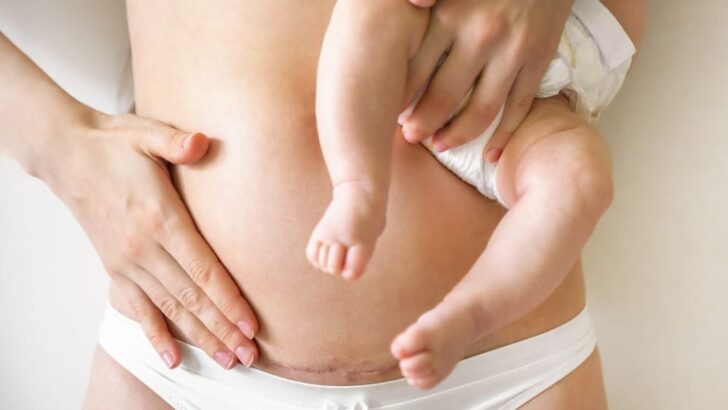 Yeast Infection On A C-Section Scar: Signs And Cures
