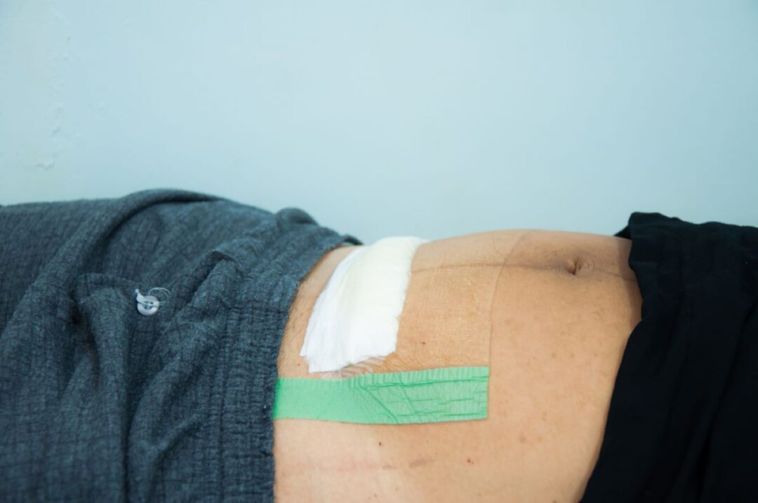 CSection Scar Overhang Getting Your Confidence Back