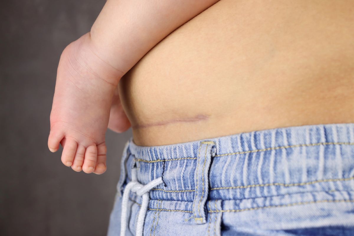 C-Section Scar Overhang: Getting Your Confidence Back