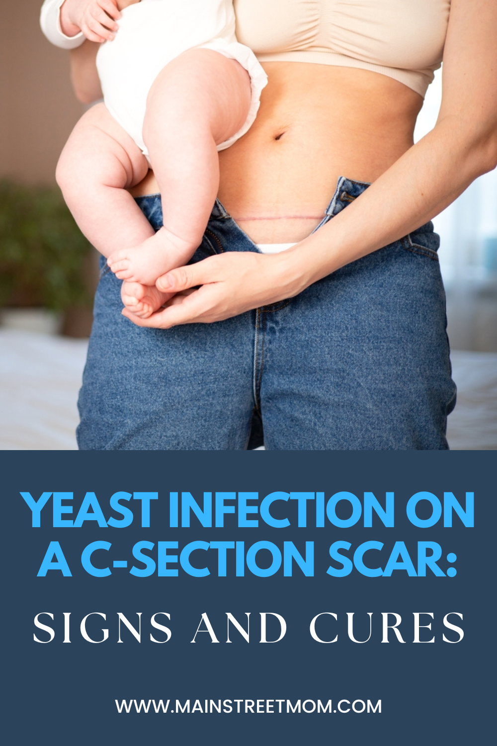 Yeast Infection On A C-Section Scar Signs And Cures